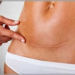 【ムカつく話】ほぼ同時期に帝王切開で出産した弟嫁と私が「産後はきつかったよねー」と盛り上がってたら、バカ弟が信じられない一言を発した