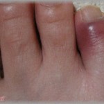 【恐怖】薬指に靴ずれが出来た。膿むようになって親指くらいの太さになったがあんまり痛くないしそのままにしておいた。 ある日、いつものように膿をちょいと絞り出すつもりで傷口周辺を抑えたら・・・