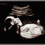 【複雑】嫁の兄嫁が産婦人科へ行ったら胎児が無脳症で心臓も止まっているので手術で胎児を取り出すとのこと…。義父から俺の嫁を手伝いで行かせた方がいいか？と連絡があったけど、俺の嫁さんも今妊娠中で…