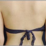 【悲】昨日整体に行ったんですよ。すっごい気持ちよかったんですよ。しかし吸盤に吸われた背中を見てみたら死にたくなった。